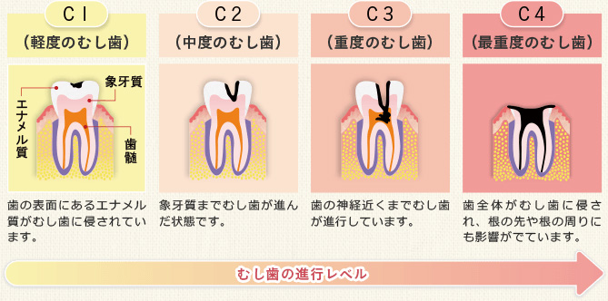 むし歯の進行の様子