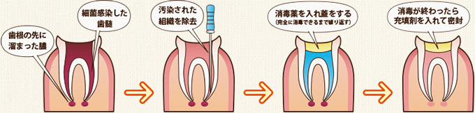 根管治療の流れ