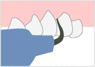 PMTC（歯石除去）