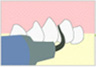 1.歯石・歯垢除去