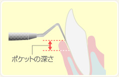 ポケット検査