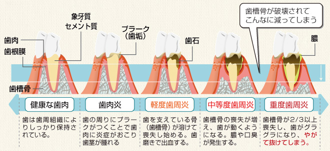 歯周病の進行の様子